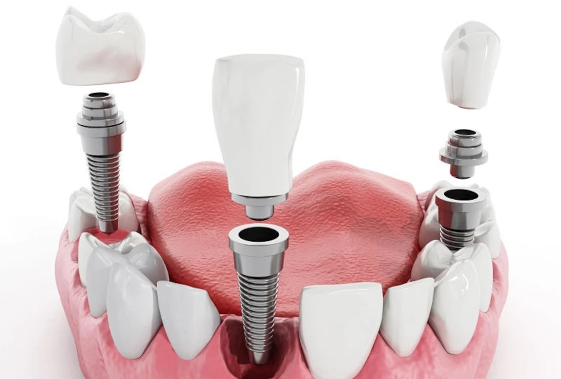 عدد سنوات دراسة طب الأسنان في مصر